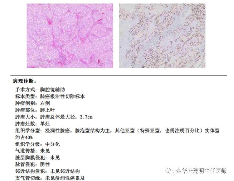 左肺占位被安排穿刺活检是肺癌吗,肺癌肺部穿刺有什么危险