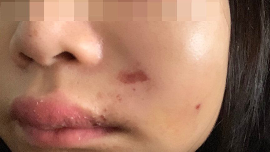 女子整容做酒窝失败,人造酒窝手术的样子