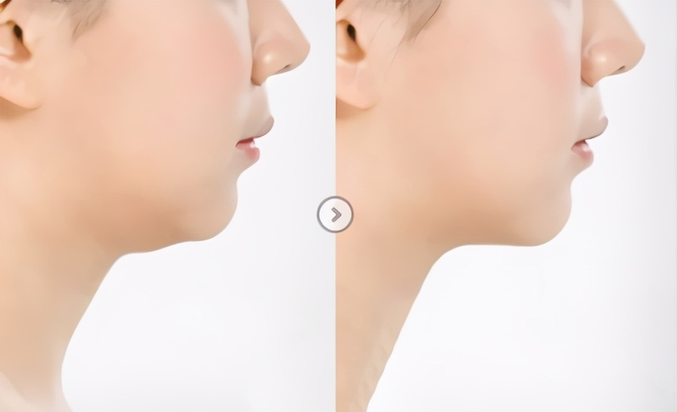 年纪轻轻为什么下垂了,年纪轻轻就下垂的厉害