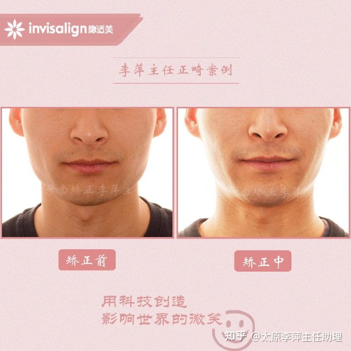 太原牙齿矫正靠谱吗,太原成人隐形牙套牙齿不齐