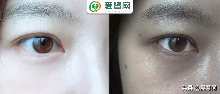 变黑、瘙痒、干燥，透析肾友常见的皮肤损害，到底该怎么办？