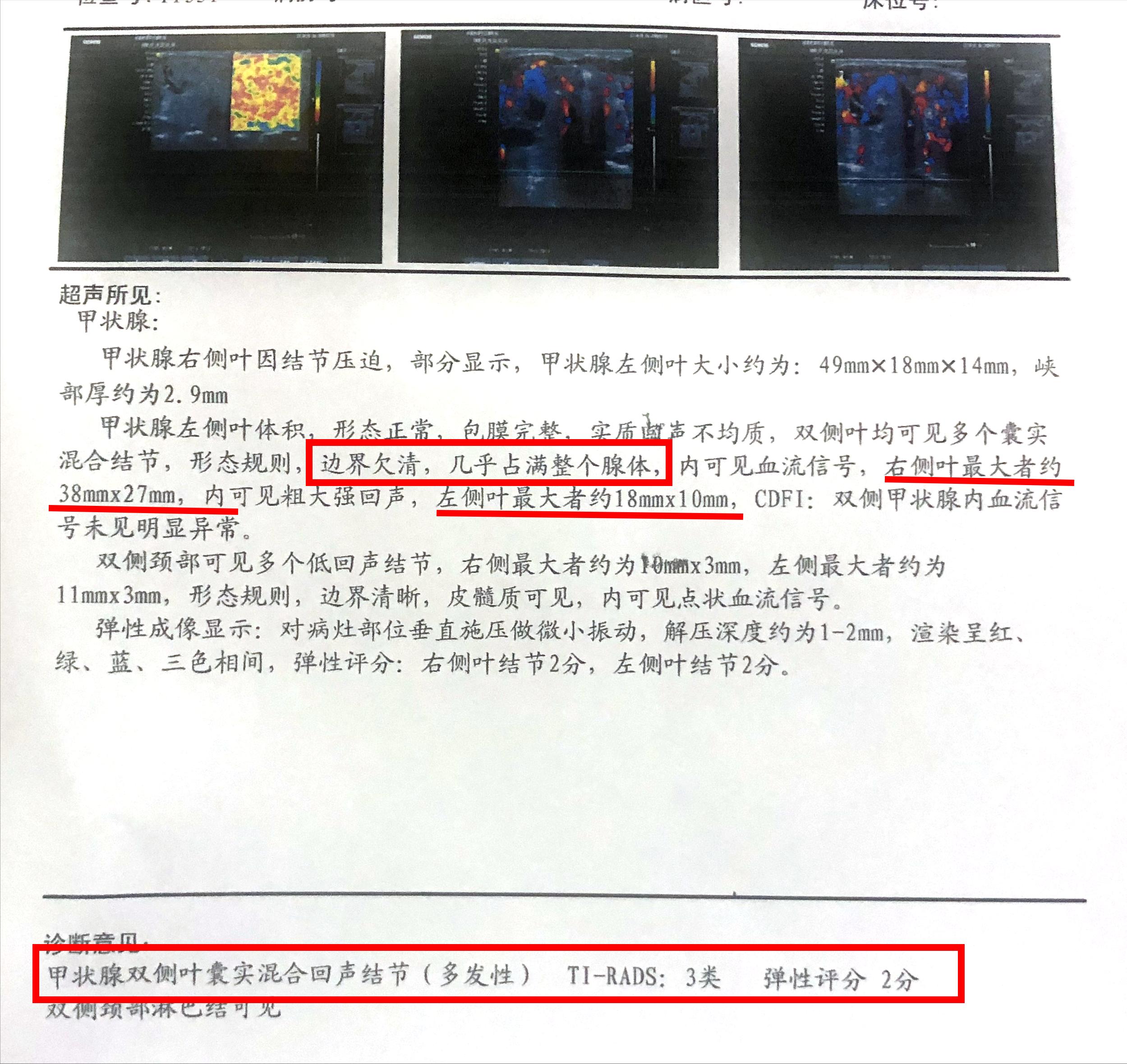 甲状腺结节垂直位癌变的几率多大,甲状腺结节多个结节融合而成