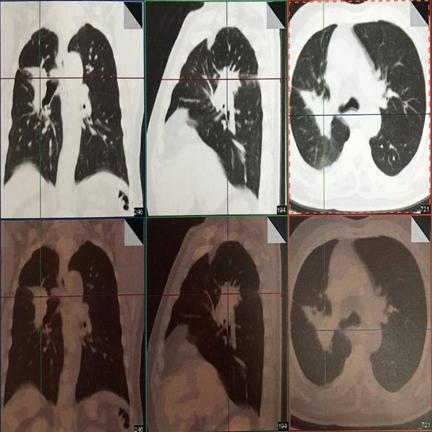 局部放疗能彻底治好吗,放射治疗全过程两大阶段