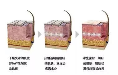 关于水光针，你被忽悠了吗？