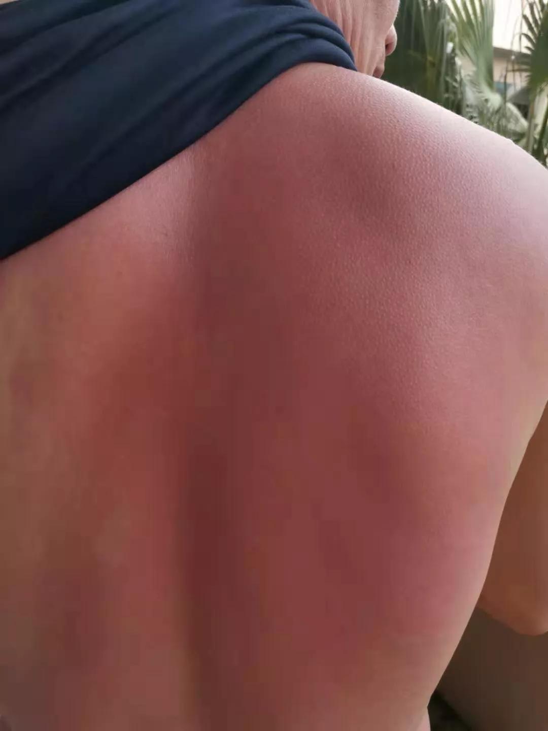 洪水之后需要关注的地方,洪水容易造成什么皮肤病