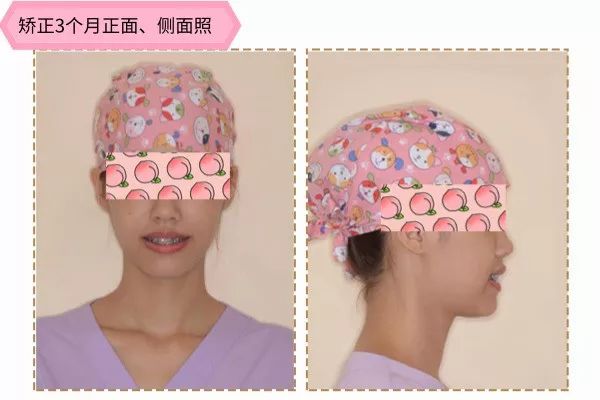 有兔牙如何改善,兔牙怎么矫正