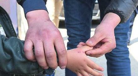 被老鼠咬了应该打什么疫苗,被老鼠咬了必须要打狂犬疫苗吗