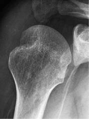 肩关节评定量表cms,肩关节功能评估法cms