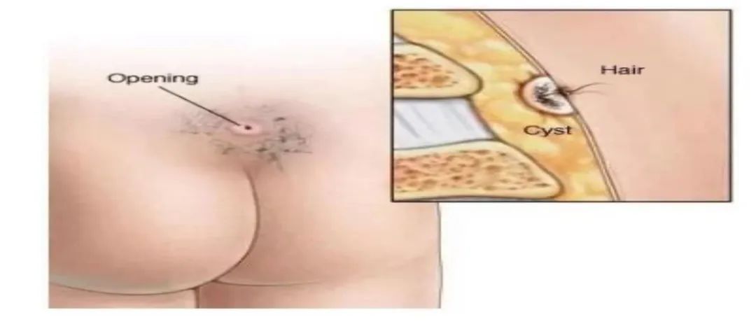 毛发逆生长谨慎藏毛窦,尾部藏毛窦治疗方法