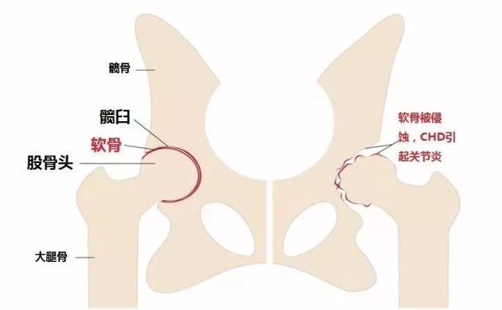 髋关节出了问题一个动作自测,这些症状你千万别再轻忽了