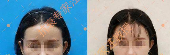 眼袋泪沟怎么消除学生,眼袋泪沟怎么消除视频教程