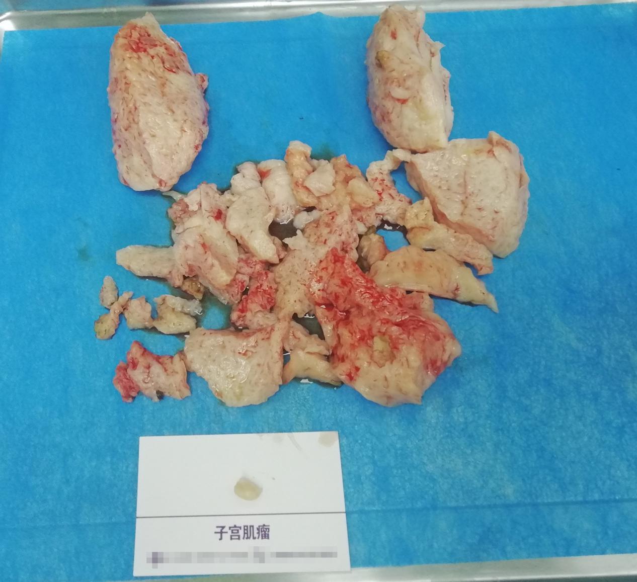 她得了这个怪病后，每次来月经都要用掉15片纸尿裤、60片姨妈巾