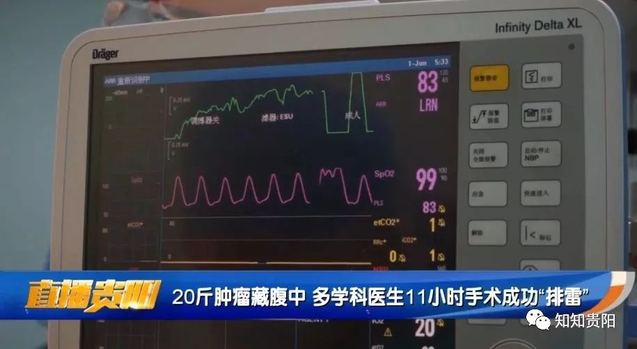 腹部巨大肿瘤医生说只能活3天,腹腔30斤肿瘤