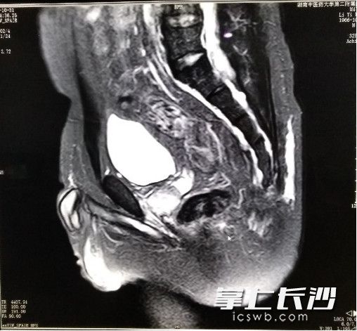 20多岁男子肛瘘怎么回事,患者男45岁因肛瘘入院治疗