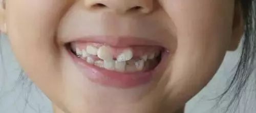 乳牙龋坏影响恒牙发育吗,乳牙蛀牙不疼会不会影响到牙神经