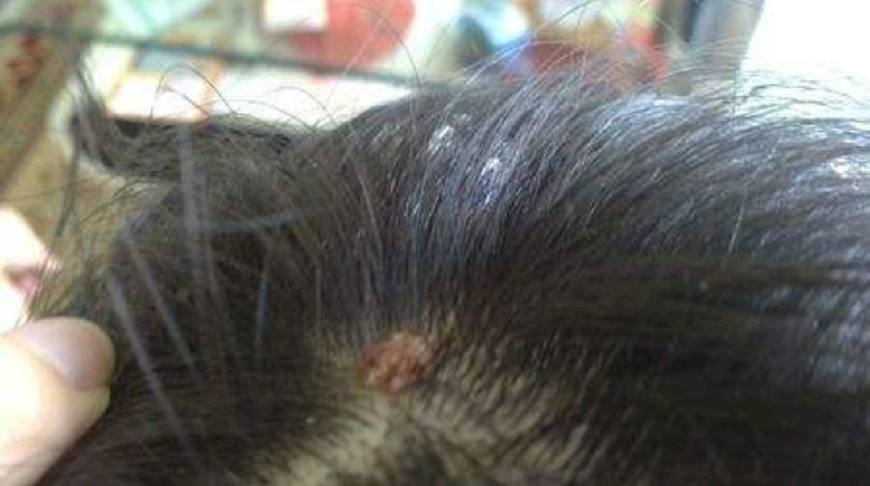 头皮长痘痘什么原因,头皮里面长痘痘是什么原因呢