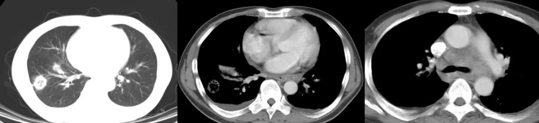 肺结核防控诊疗方案,成功治疗肺结核病的关键