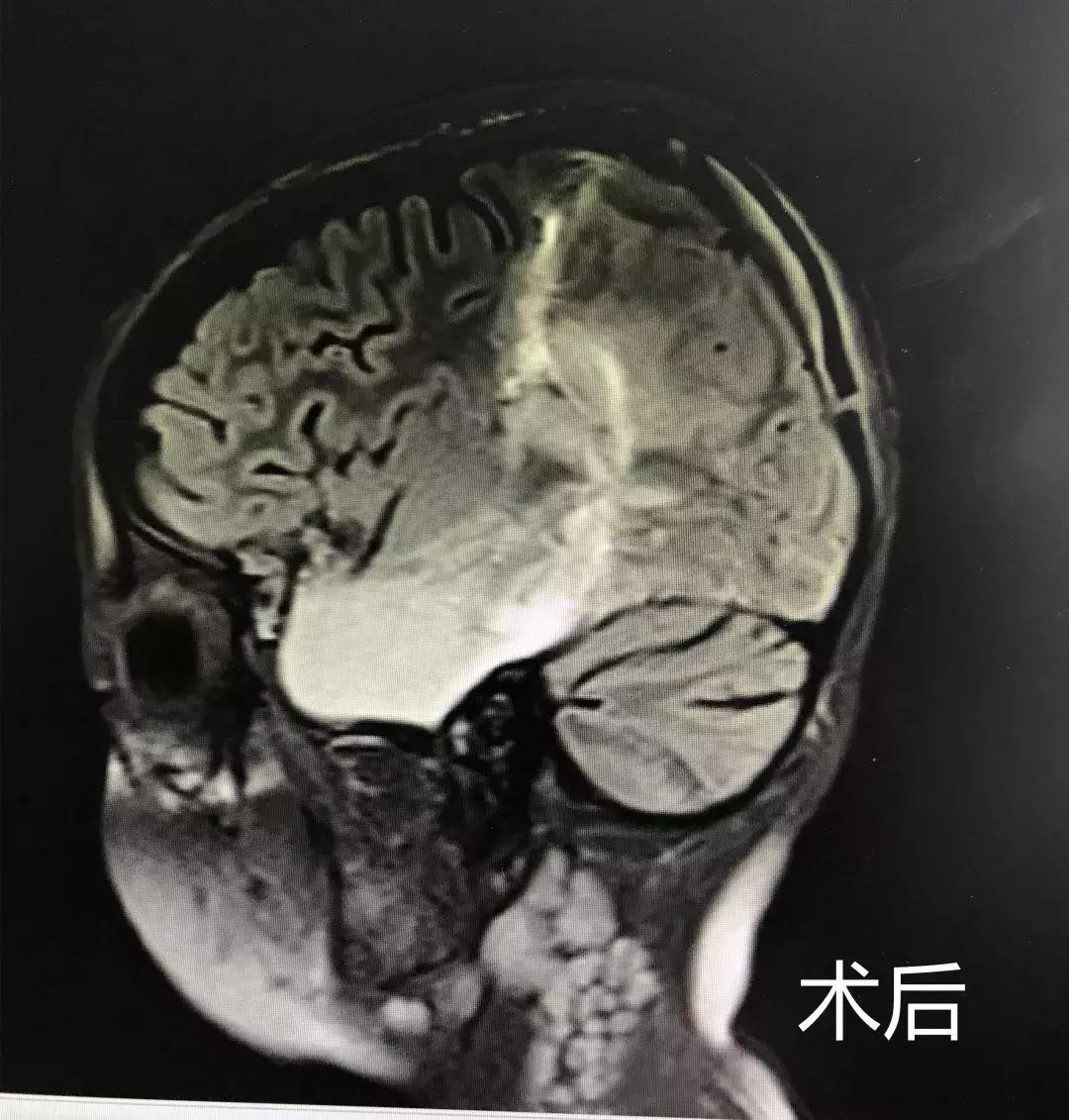 儿童癫痫可怕家长寝食难安,小孩癫痫家长的采访