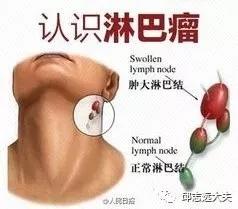 淋巴瘤科普讲堂视频,常见肿瘤答疑解难