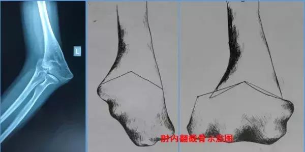 孩子胳膊向外弯怎么回事,小孩胳膊肘往内拐什么原因