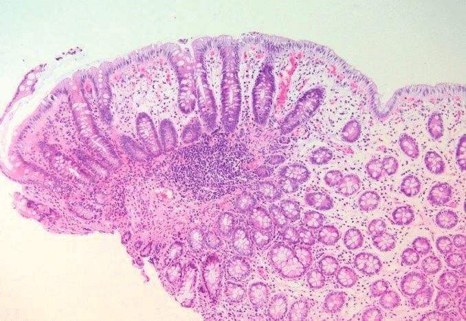 为什么有的人吃过肉难受,晚上肉吃多了胃难受怎么办