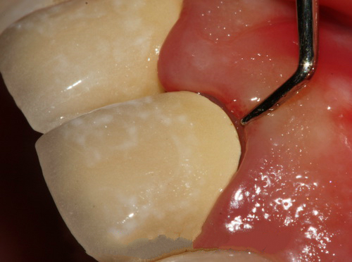 烤瓷牙做了人变丑了,烤瓷牙套里的牙烂了有什么症状