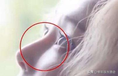 塌鼻梁、鼻根低整个鼻子趴在脸上想垫高怎么办？