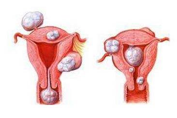 妇科疾病的介入治疗，这四种妇科疾病不用切除子宫也可以治好