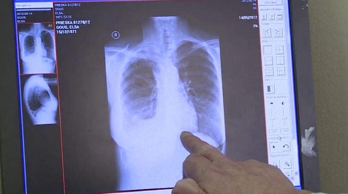 现在农村的石棉瓦有危害吗,石棉瓦盖房子有危害吗