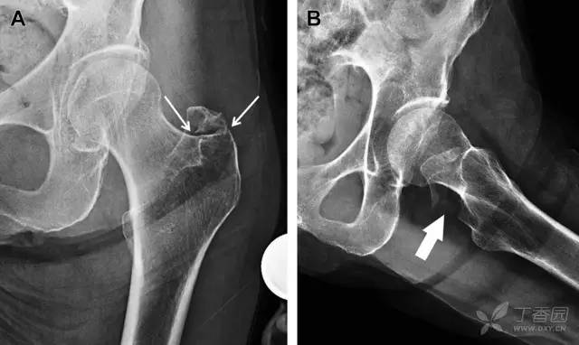 常见的八种骨折,容易漏诊的肩关节骨折