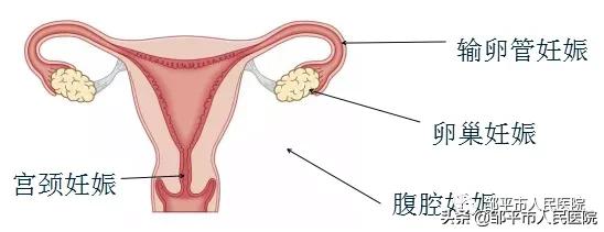 异位妊娠易发生在输卵管哪个部位,输卵管异位妊娠通常会在哪