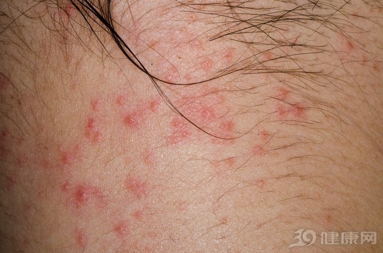 中医治湿疹最好的方子,中医治疗湿疹七大药方