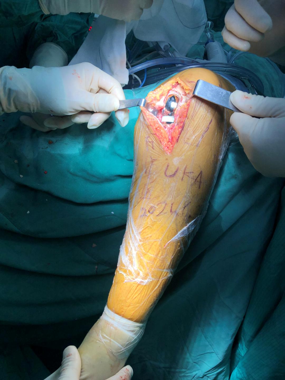 百色市人民医院关节外科开展膝关节单髁置换术，保膝技术再添“法宝”