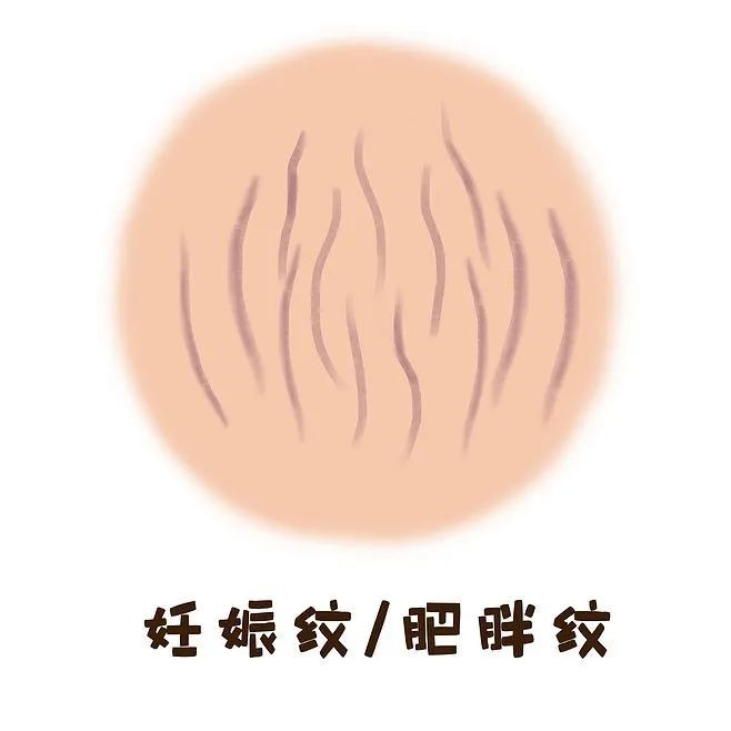 没怀孕却长了妊娠纹怎么办,没怀孕突然长妊娠纹
