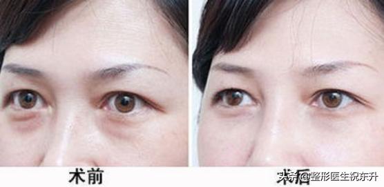 下眼皮下垂松弛可以打针吗,下眼皮睁不开是怎么回事