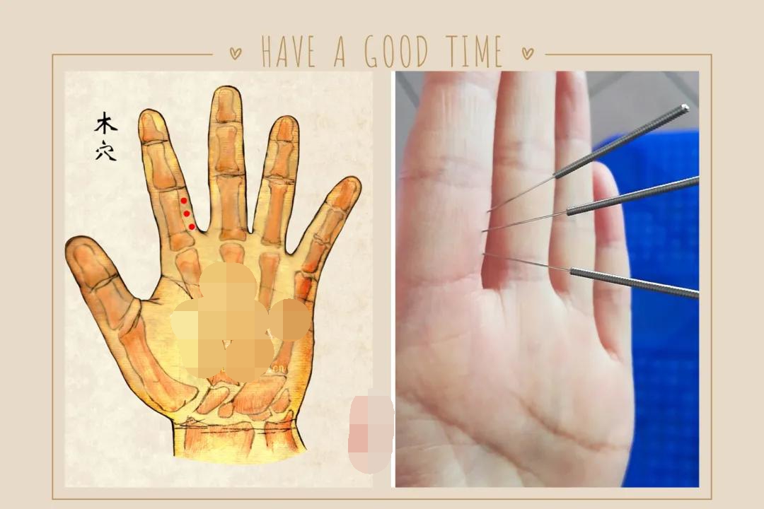 上呼吸道感染症状针灸穴位,上呼吸道感染针灸哪里效果最好