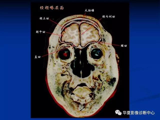 mra头颅解剖学详细讲解视频,常见的头颅mri图像