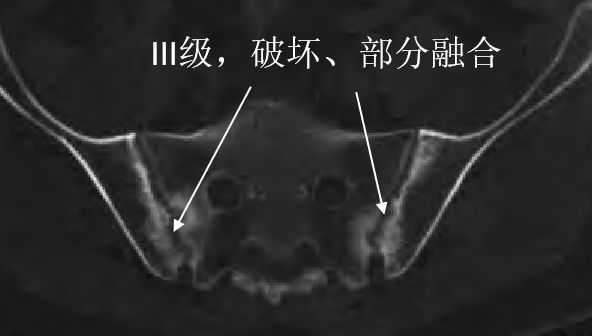 强直性脊柱炎骶髂关节二级改变,强直性骶髂关节炎等级