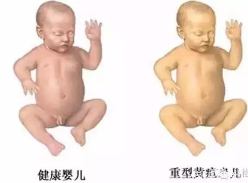 家有“小黄人”宝宝可不是闹着玩儿的！分清新生儿黄疸很重要