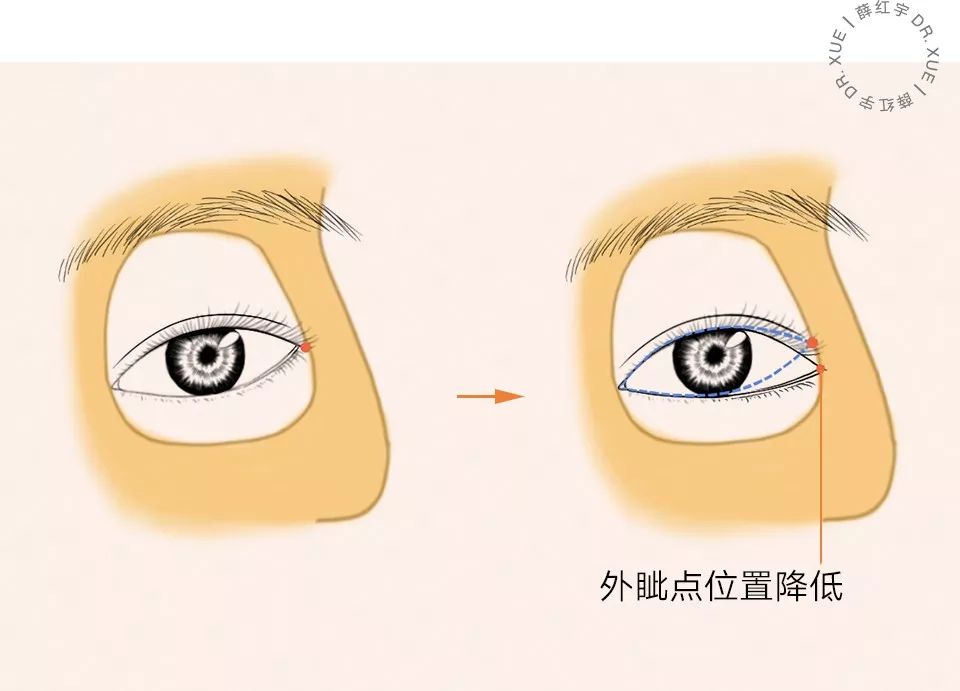 什么样的眼睛适合开外眼角,要不要做内外眼角