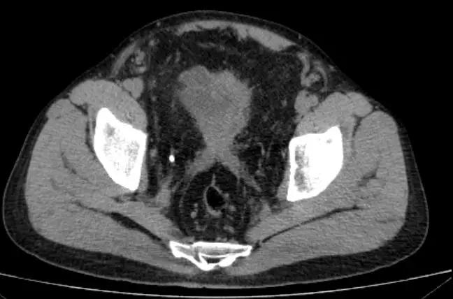 OMG！脂肪长到盆腔里！吓得我赶紧扔掉了手里的鸡腿肉