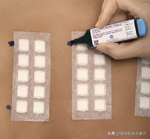 过敏去皮肤科主要检查什么,过敏就诊皮肤科应该怎么说