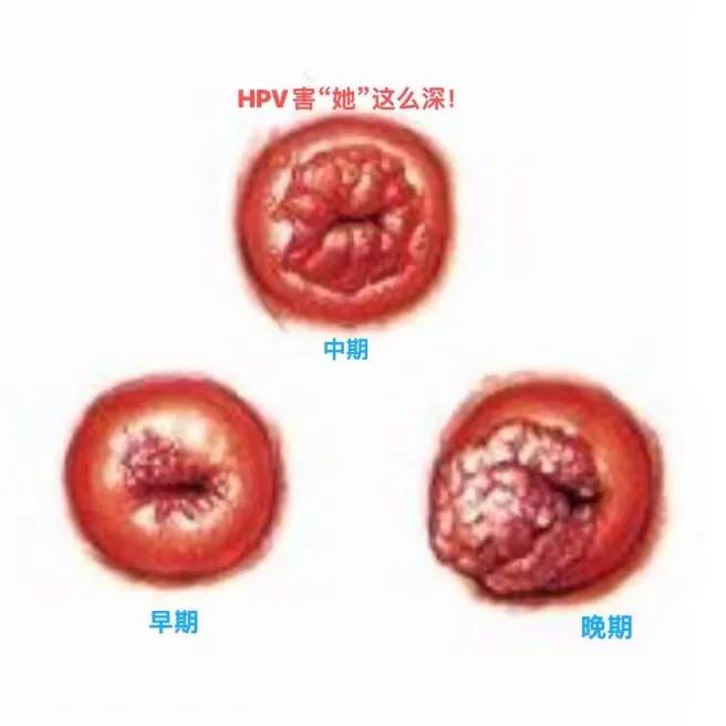 hpv每个女人都会经历么,hpv伤害性有多大