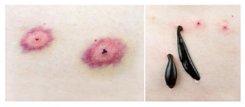 在野外被蚂蟥吸血了怎么办,户外登山如何防蚂蟥