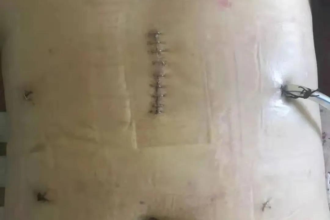 微创胃癌切除手术成功,腹腔镜下胃癌手术