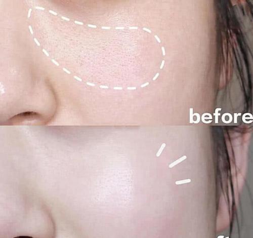 鼻子上的黑头怎么去得掉,鼻子上的黑头很痛怎么办