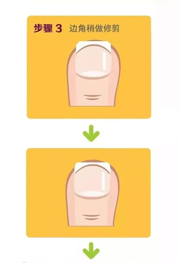 指甲老往肉里长化脓,指甲为什么一直往肉里长