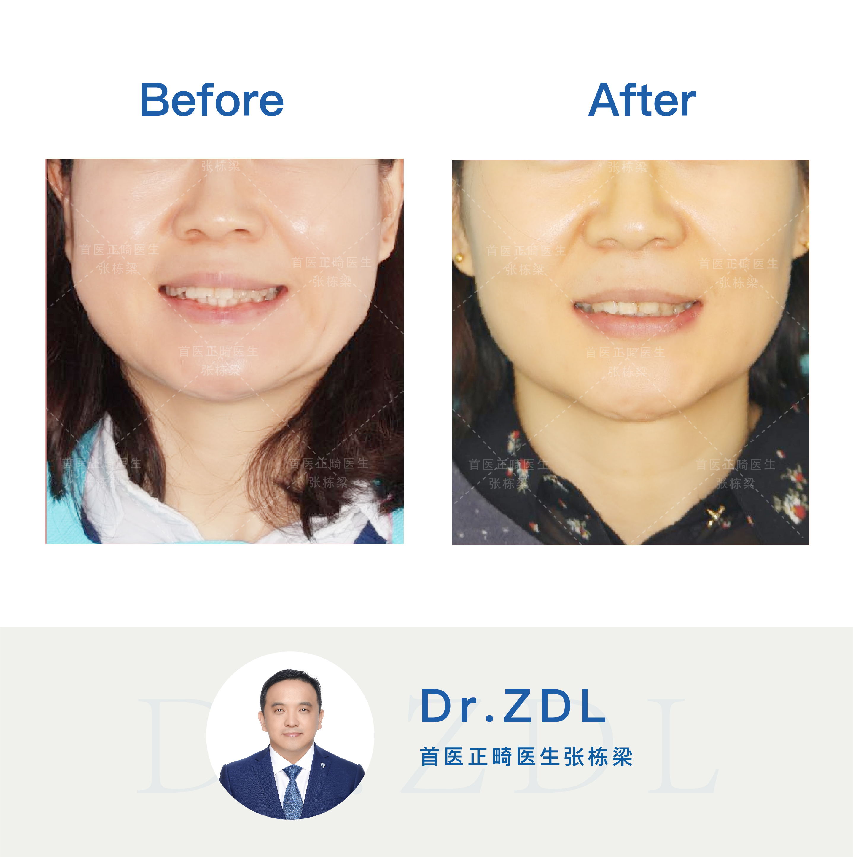 24岁戴牙套矫正效果能有效吗,40岁戴隐形牙套矫正牙齿经历