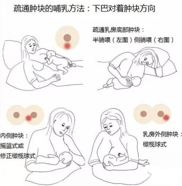 哺乳期堵奶脓包破了怎么办,哺乳期皲裂堵奶怎么办