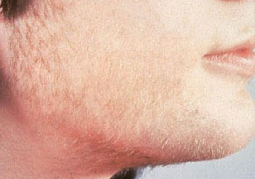 意大利女子牙龈长出睫毛状毛发，历经8年未治愈，病因很常见